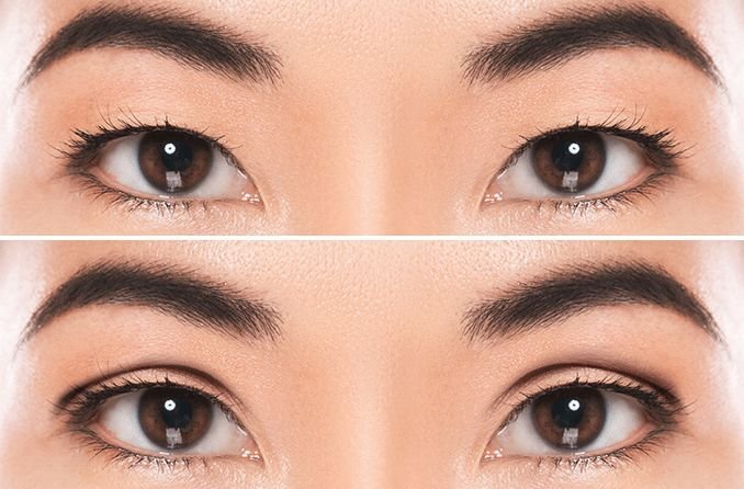 double eyelid surgery in Korea