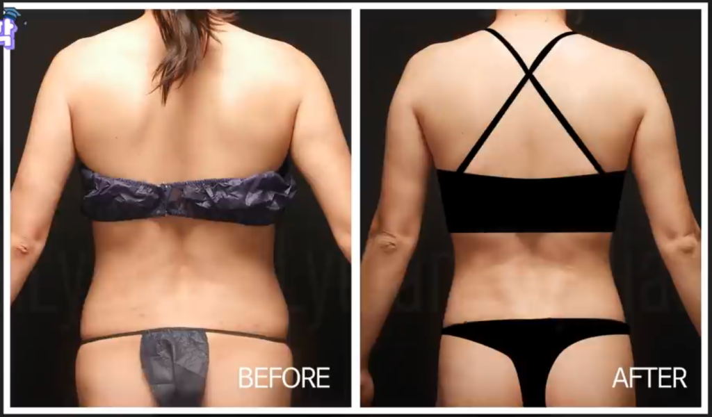 back fat liposuction at Lydian in Korea