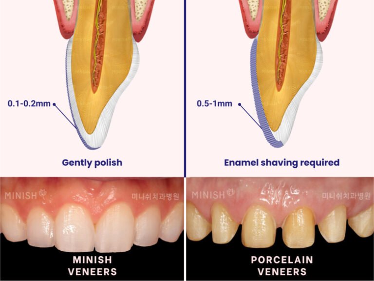 Veneers in South Korea