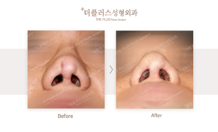 Rhinoplasty for men in Korea.