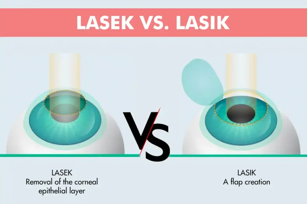 LASIK vs, LASEK