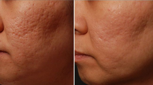 before and after acne scar treatment in Korea