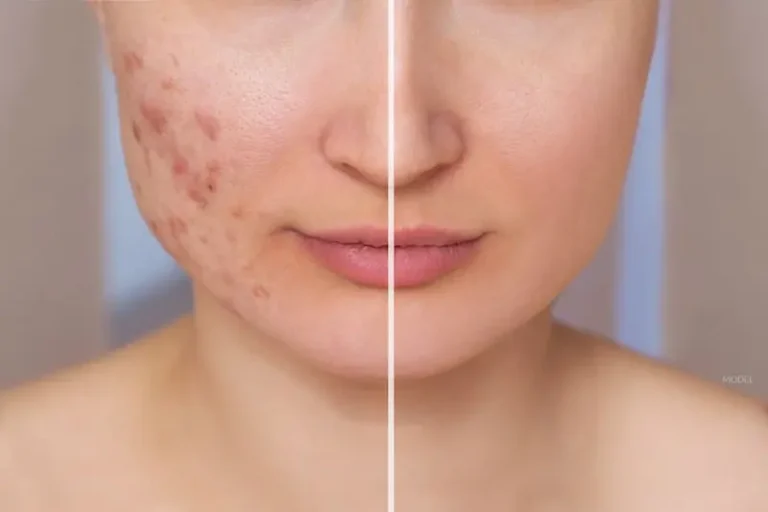 acne scar treatment in Korea