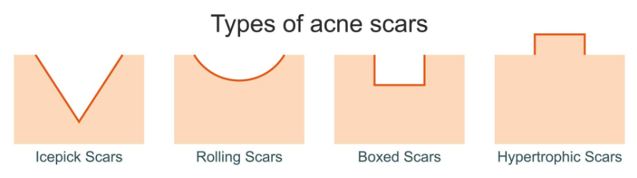 types of acne scars
